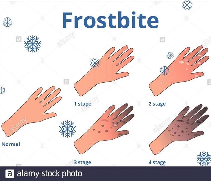 The different steps for frostbite. 